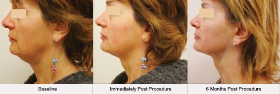 Ultraformer results