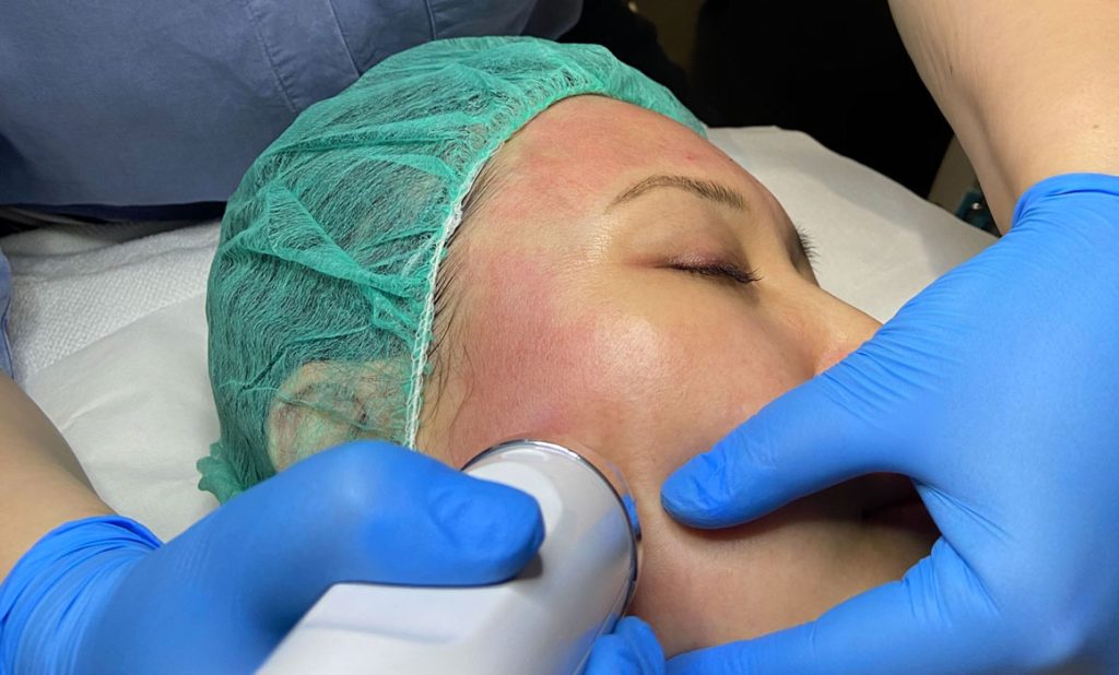 RF Needling in action at our randwick skin clinic