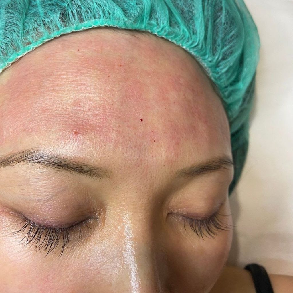 RF Micro-needling used by Jodie, dermal clinician