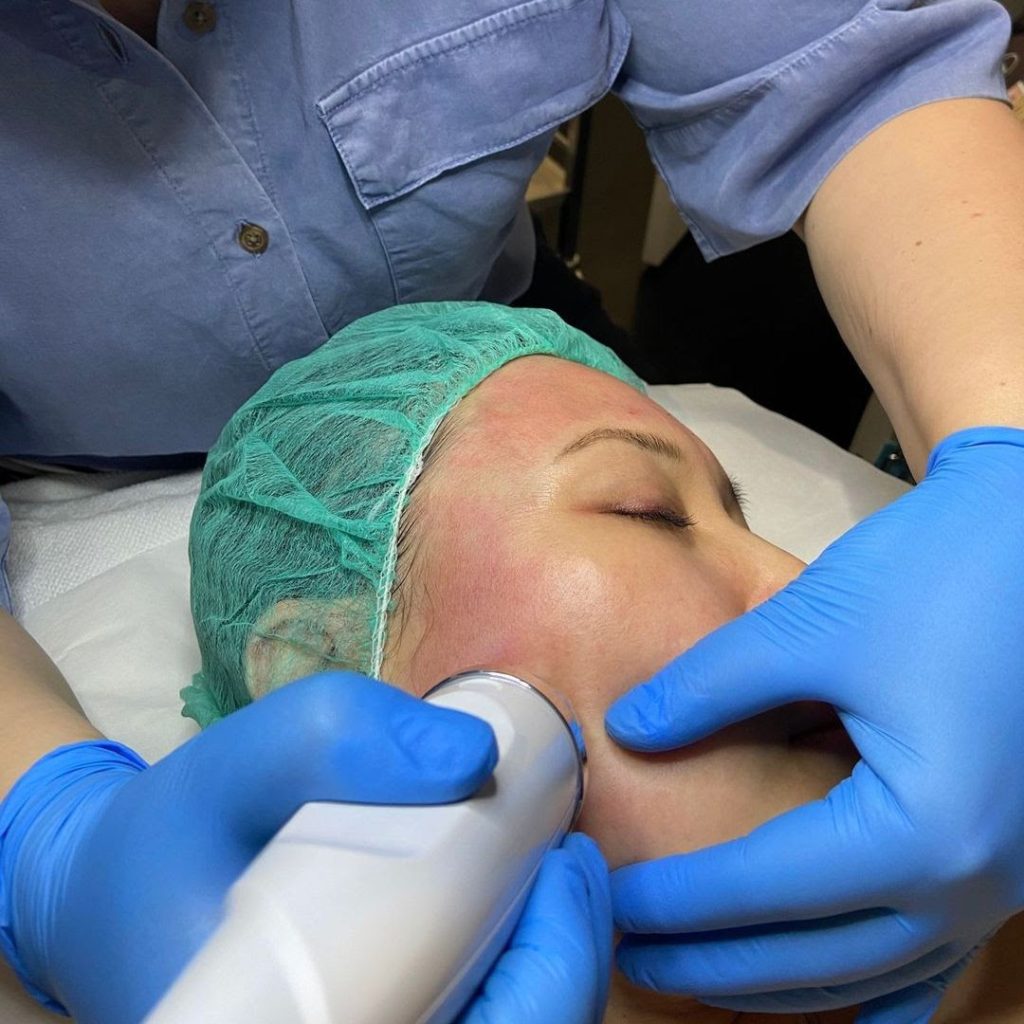 RF Micro-needling used by Jodie, dermal clinician
