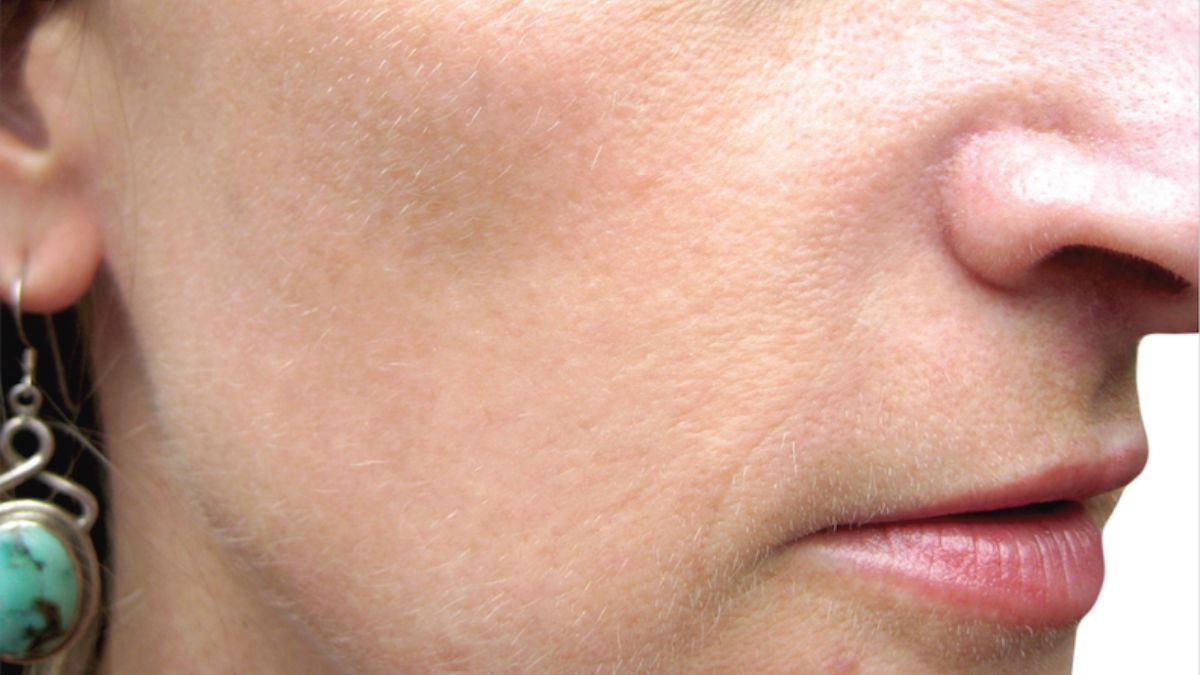Close-up of a woman's face after BBL treatment