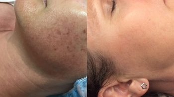 Close-up of a woman's face before and after Pigmentation BBL treatment