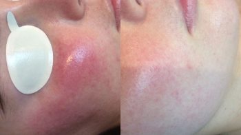 Close-up of a woman's face before and after Rosacea treatment
