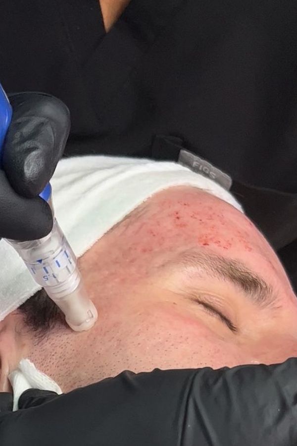Close up of skin needling pen treatment on woman's face