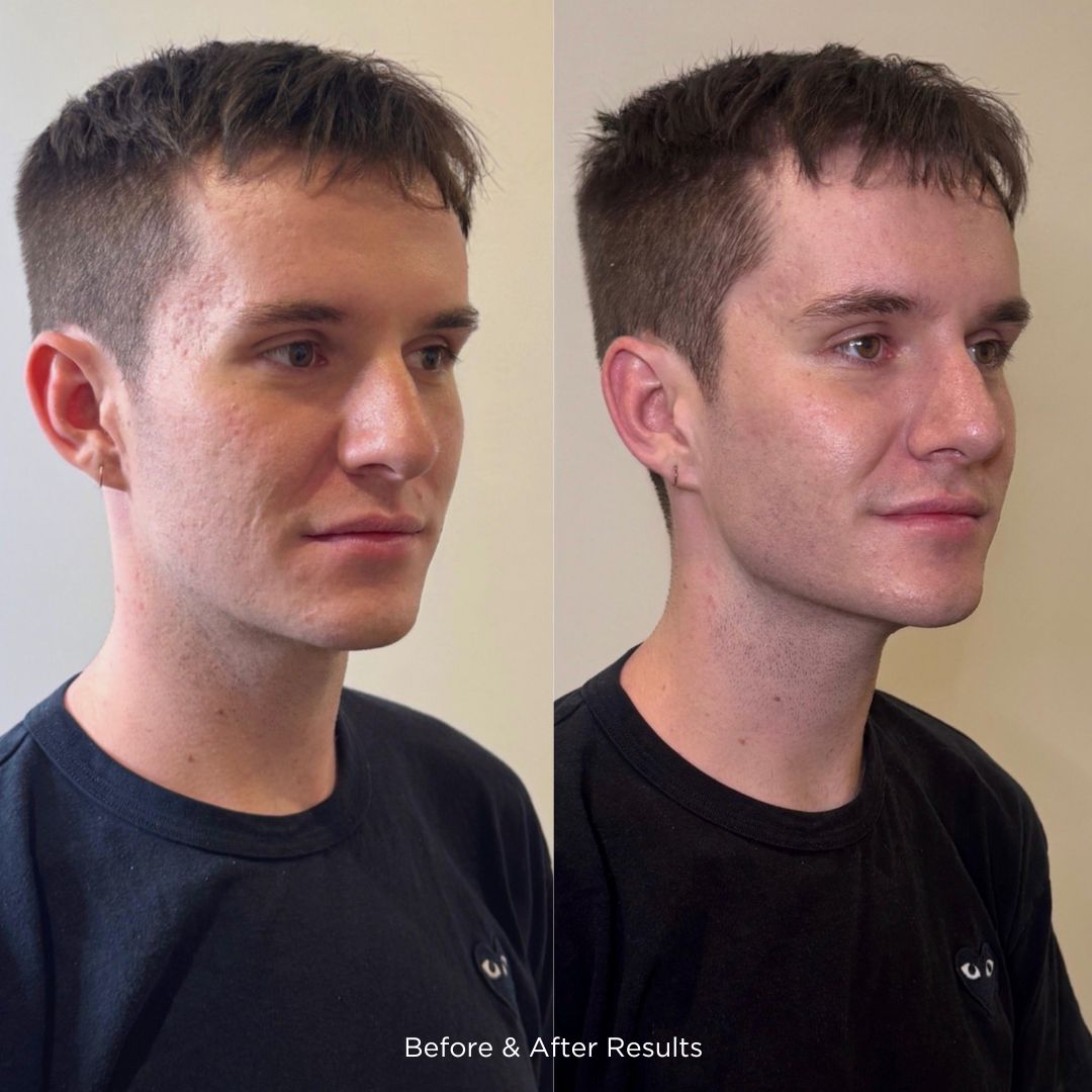 Male ultraformer patient before and after results