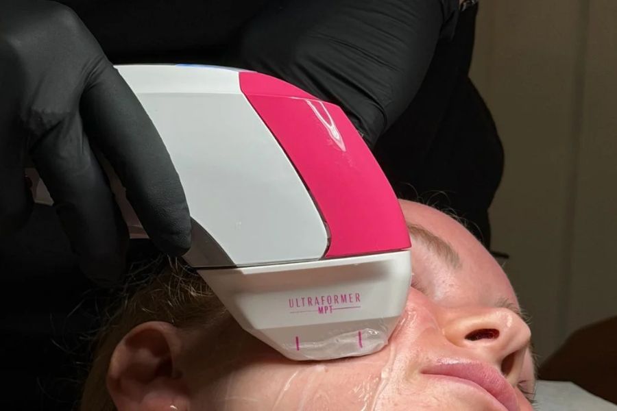 close up of woman receiving Ultraformer MPT treatment